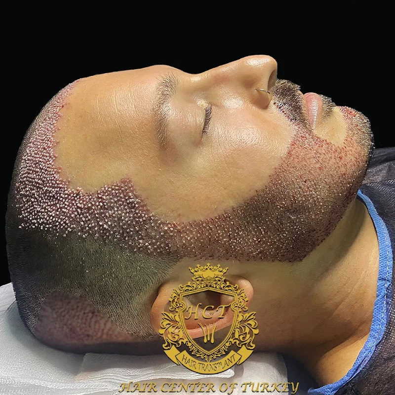 Best Hair Transplant Clinic in Turkey - Hair Center of Turkey Hair Transplant Clinic