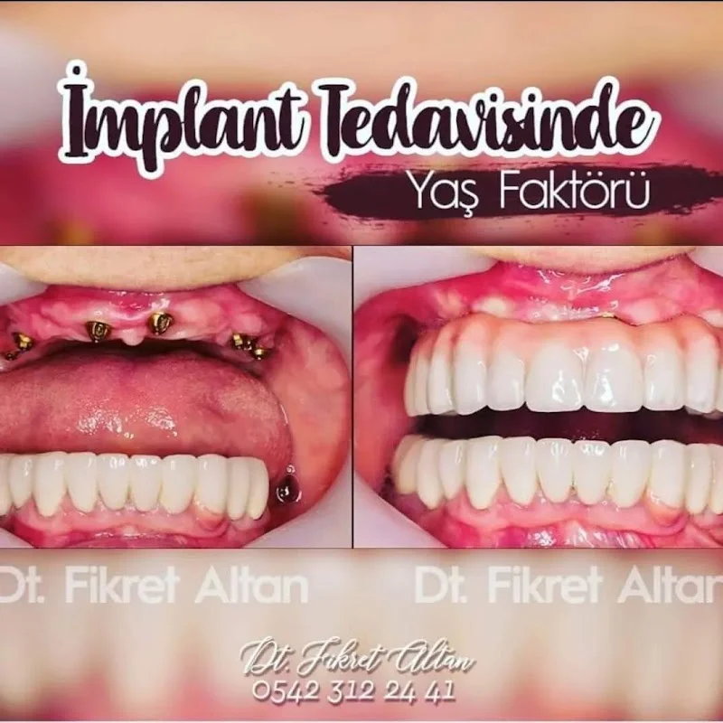 ALTAN KLİNİK | DİŞ HEKİMİ FİKRET ALTAN | İmplant, Zirkonyum, Gülüş Tasarımı, Diş Beyazlatma, Estetik Diş | Maslak İSTANBUL