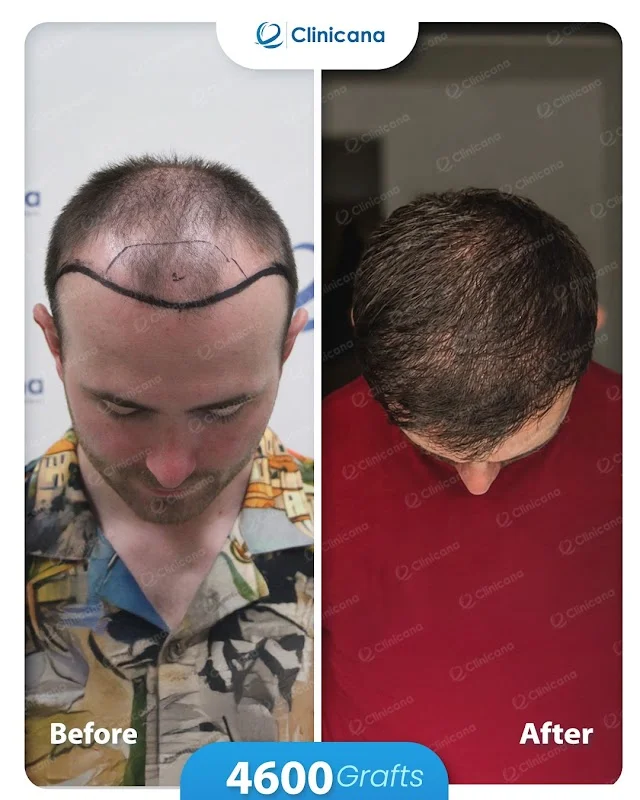 Clinicana Hair Transplant & Esthetic Surgeries Istanbul Turkey