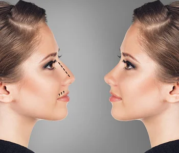 Istanbul Plastic Surgery Support - ( Vaser Liposuction, Nose Job, Tummy Tuck, BBL, Facelift, Implants, Laser, Lip Lift, Gynecomastia)