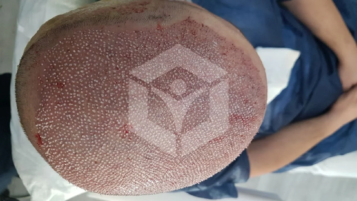 Beauty Hair Transplant in Turkey - Istanbul