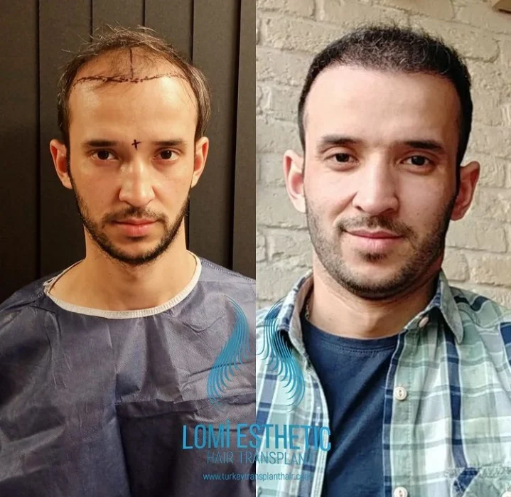 Lomi Esthetic Hair Transplant