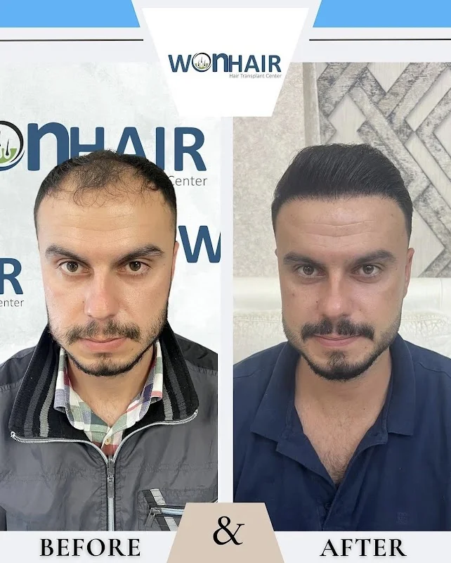 Won Hair Transplant Center
